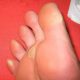 Sign of Corns or Calluses, Know its Home Remedies